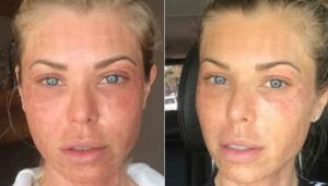 Modelo mostra antes e depois realista de tratamento de beleza: como funciona? Di?
